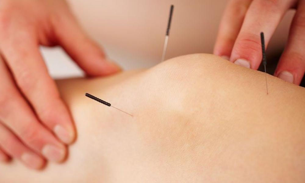 Acupuncture