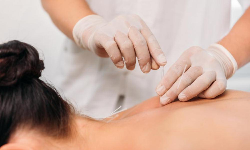 acupuncture
